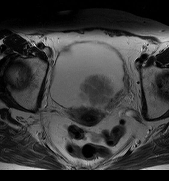 File:Bladder tumor detected on trauma CT (Radiopaedia 51809-57639 Axial T2 6).jpg
