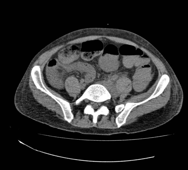 File:Bowel lymphoma complicated by bleeding after therapy (Radiopaedia 55601-62110 Axial non-contrast 58).jpg