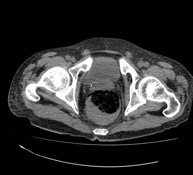 File:Bowel lymphoma complicated by bleeding after therapy (Radiopaedia 55601-62110 Axial non-contrast 79).jpg