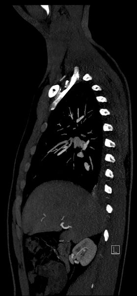 File:Brachiocephalic trunk pseudoaneurysm (Radiopaedia 70978-81191 C 33).jpg