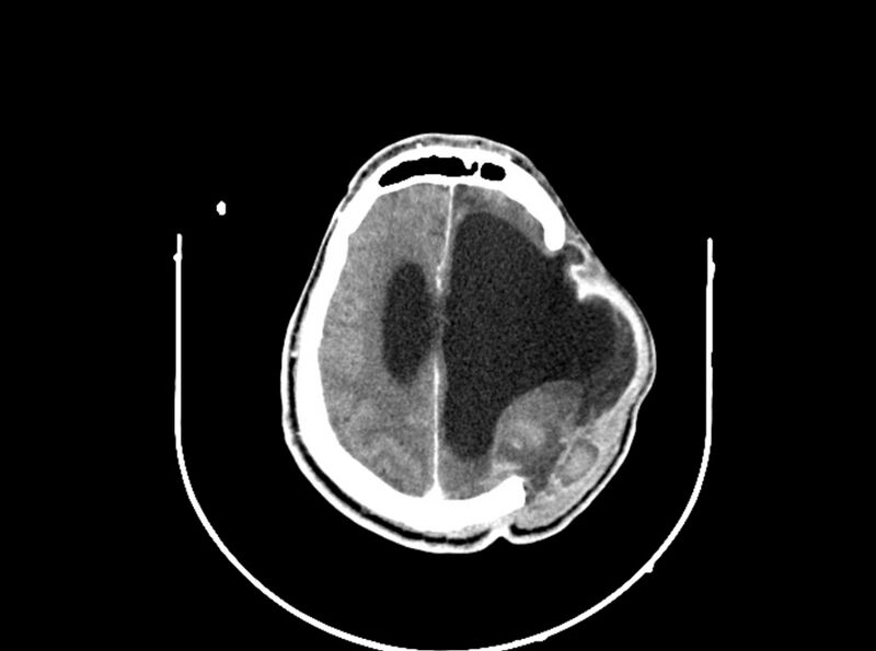 File:Brain injury by firearm projectile (Radiopaedia 82068-96088 B 162).jpg