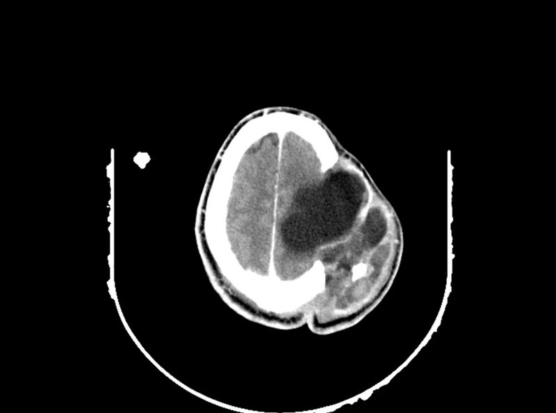 File:Brain injury by firearm projectile (Radiopaedia 82068-96088 B 180).jpg