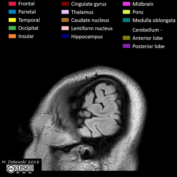 File:Brain lobes - annotated MRI (Radiopaedia 61691-69700 Sagittal 1).JPG