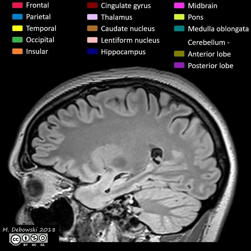 Brain lobes - annotated MRI (Radiopaedia 61691-69700 Sagittal 25).JPG