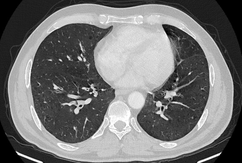 File:Brain metastases - lung cancer primary (Radiopaedia 75060-86116 Axial lung window 39).jpg