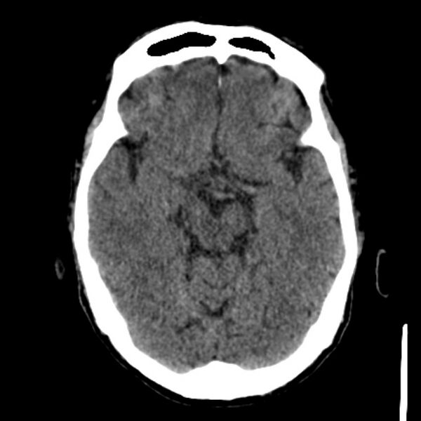 File:Brain metastases from lung cancer (Radiopaedia 27849-28092 Axial non-contrast 19).jpg