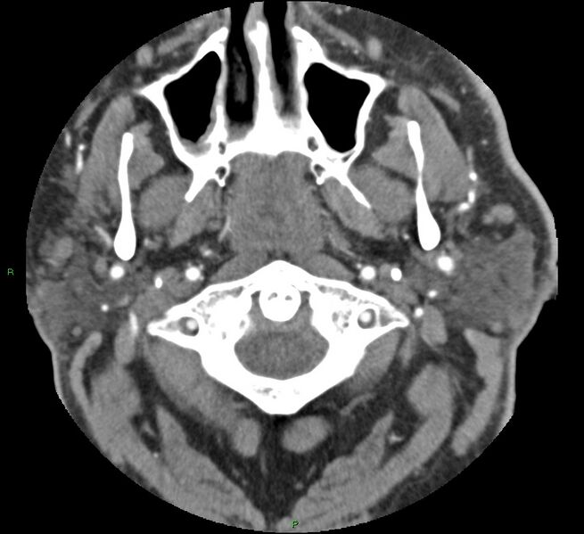 File:Brainstem hemorrhage (Radiopaedia 58794-66028 D 1).jpg