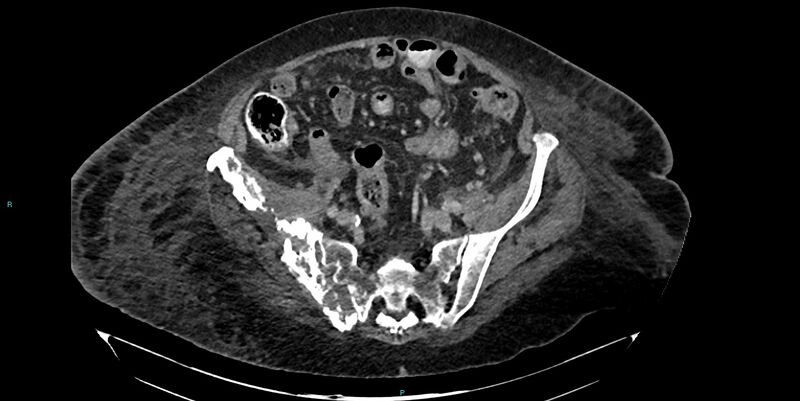 File:Breast cancer pelvic bony metastases (Radiopaedia 84470-99824 Axial bone window 32).jpg