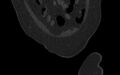 Breast carcinoma with pathological hip fracture (Radiopaedia 60314-67993 Coronal bone window 33).jpg