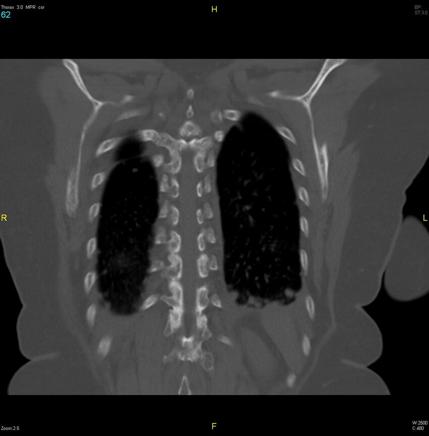 Breast primary with lung and bone metastases (Radiopaedia 40620-43228 bone window 62).jpg