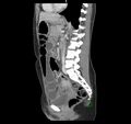 Broad ligament hernia (Radiopaedia 63260-71832 C 30).jpg