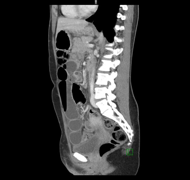 File:Broad ligament hernia (Radiopaedia 63260-71832 C 30).jpg
