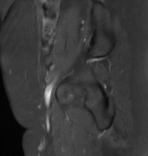 File:Broad ligament leiomyoma (Radiopaedia 81634-95516 G 4).jpg
