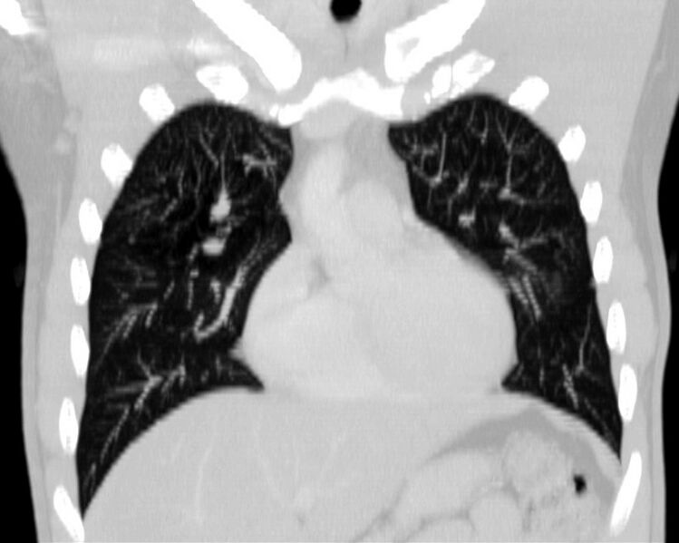 File:Bronchocele (Radiopaedia 12104-12460 Coronal lung window 5).jpg