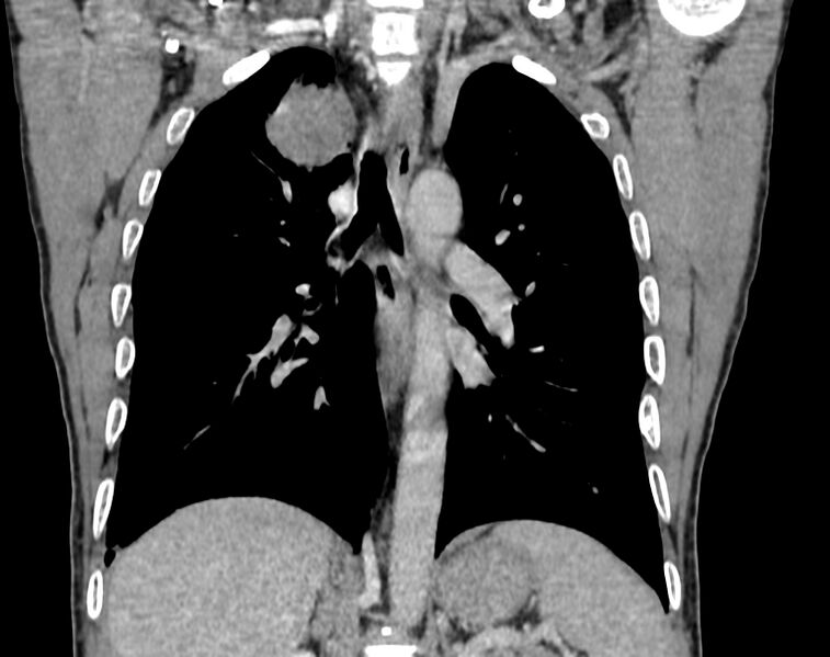 File:Bronchogenic carcinoma with superior vena cava syndrome (Radiopaedia 36497-38054 Coronal C+ delayed 64).jpg