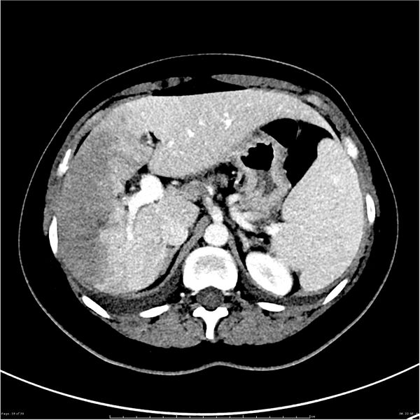 File:Budd-Chiari syndrome (Radiopaedia 27929-28177 Axial liver window 18).JPG