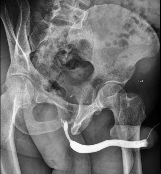 File:Bulbar urethral stricture (Radiopaedia 62859-71229 B 1).PNG