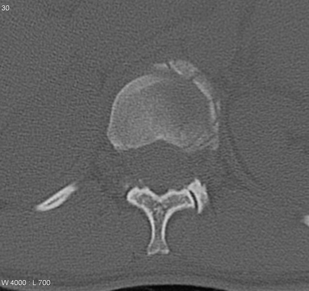 File:Burst fracture (Radiopaedia 5274-7018 Axial bone window 2).jpg