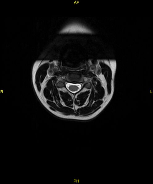 File:C5 nerve sheath tumor (Radiopaedia 85777-101596 Axial T2 12).jpg
