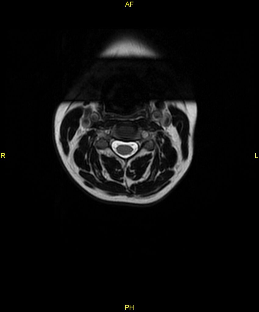 C5 nerve sheath tumor (Radiopaedia 85777-101596 Axial T2 12).jpg