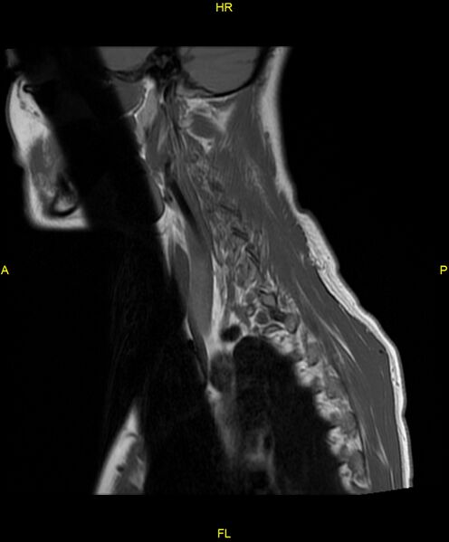 File:C5 nerve sheath tumor (Radiopaedia 85777-101596 Sagittal T1 5).jpg