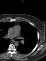 Calcified cardiac fibroma (Radiopaedia 39267-41519 Axial non-contrast 3).jpg
