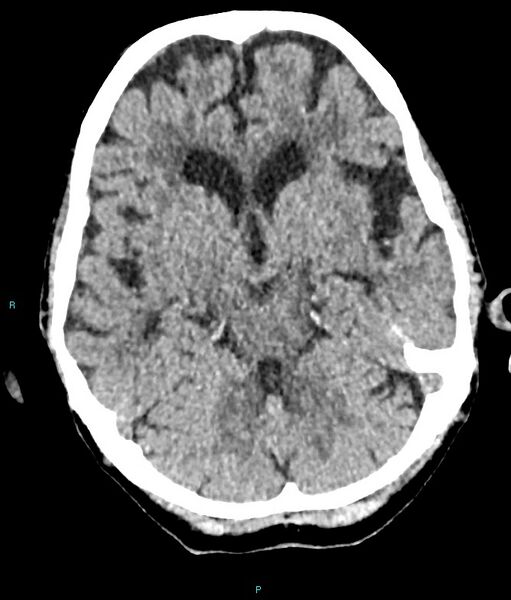 File:Calcified cerebral emboli from left ventricular thrombus (Radiopaedia 84420-99758 Axial non-contrast 61).jpg