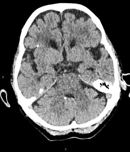 File:Calcified cerebral emboli from left ventricular thrombus (Radiopaedia 84420-99758 Axial non-contrast 64).jpg