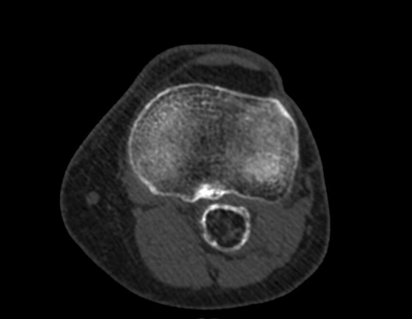 Calcified hematoma - popliteal fossa (Radiopaedia 63938-72763 Axial bone window 43).jpg