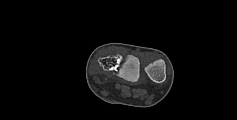 File:Calcifying aponeurotic fibroma (Radiopaedia 88423-105064 Axial bone window 25).jpg