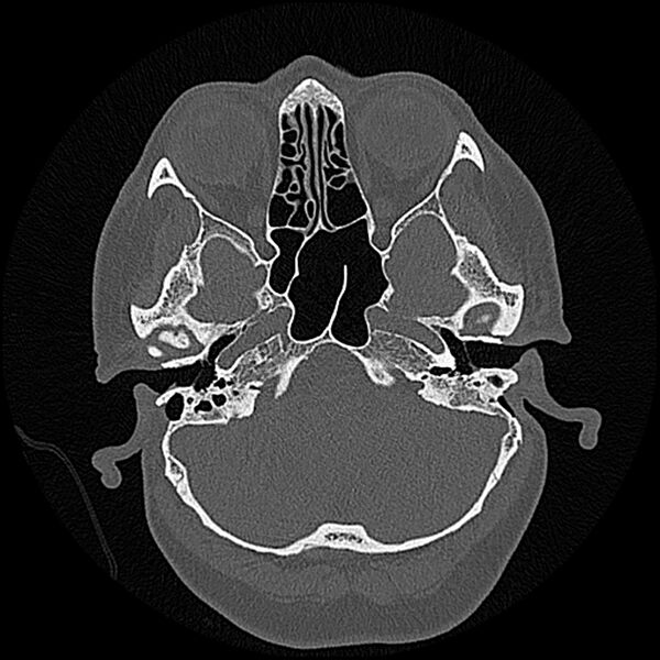 File:Canal up mastoidectomy (Radiopaedia 78108-90638 Axial bone window 55).jpg