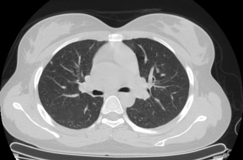 File:Cannonball metastases - uterine choriocarcinoma (Radiopaedia 70137-80173 Axial lung window 35).jpg