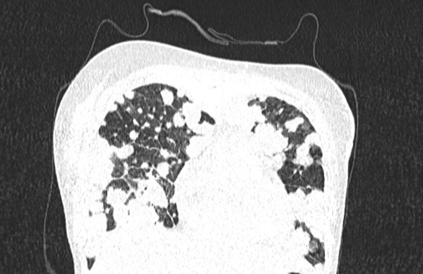 Cannonball metastases from breast cancer (Radiopaedia 91024-108569 Coronal lung window 32).jpg