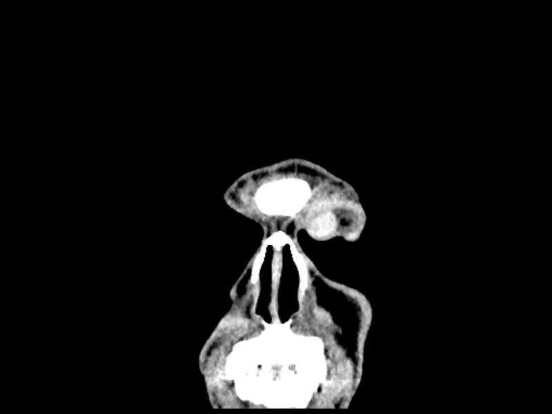 File:Capillary hemangioma of the orbit (Radiopaedia 44610-48358 B 10).jpg