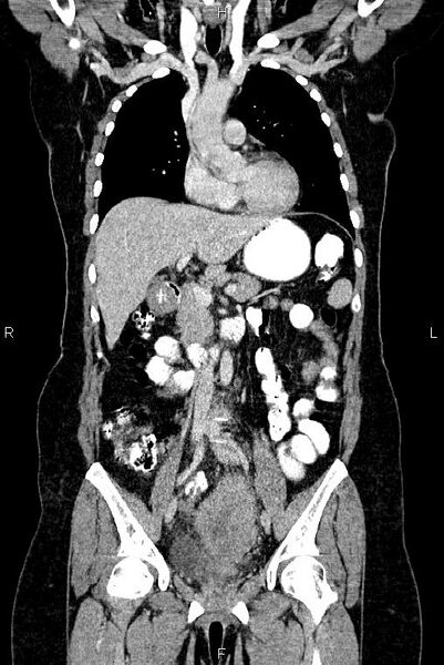 File:Carcinoma of uterine cervix (Radiopaedia 85861-101700 C 23).jpg