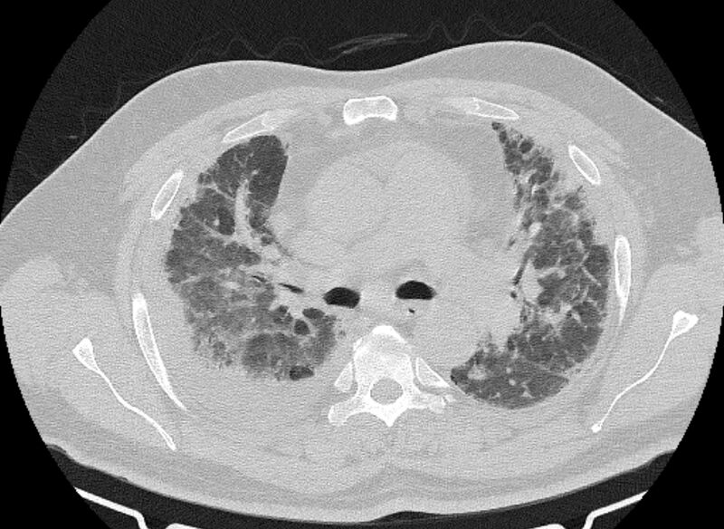 File:Cardiogenic pulmonary edema (Radiopaedia 68180-77678 Axial lung window 35).jpg