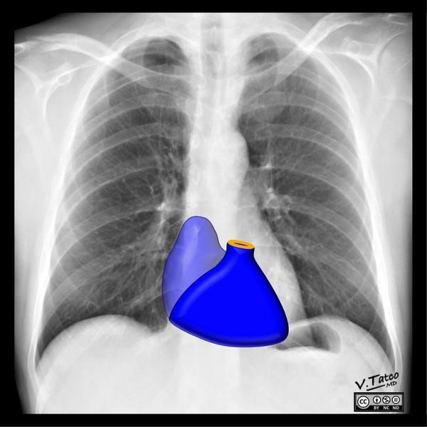 File:Cardiomediastinal anatomy on chest radiography (annotated images) (Radiopaedia 46331-50742 E 1).png