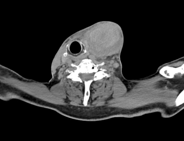 File:Carotid artery pseudoaneurysm (Radiopaedia 84030-99259 Axial non-contrast 38).jpg