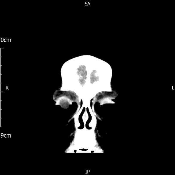 File:Cavernous sinus thrombosis (Radiopaedia 79414-92510 Coronal Brain 14).jpg