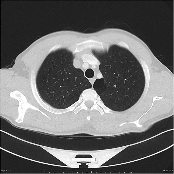 File:Cavitating lung cancer (Radiopaedia 25796-25945 Axial lung window 8).jpg