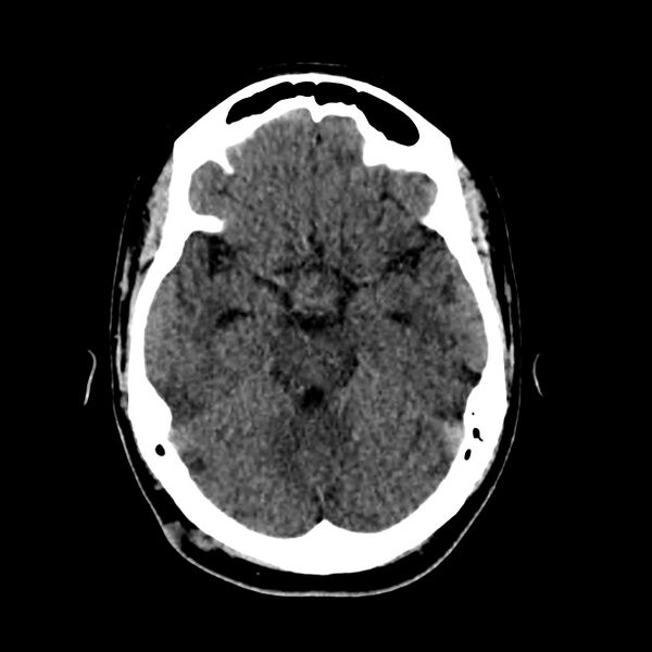 File:Central nervous system Langerhans cell histiocytosis (Radiopaedia 65728-74878 Axial non-contrast 20).jpg