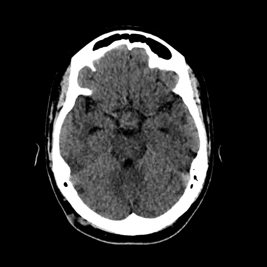 Central nervous system Langerhans cell histiocytosis (Radiopaedia 65728-74878 Axial non-contrast 20).jpg