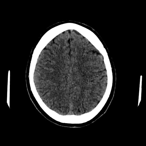 File:Central nervous system Langerhans cell histiocytosis (Radiopaedia 65728-74878 Axial non-contrast 38).jpg