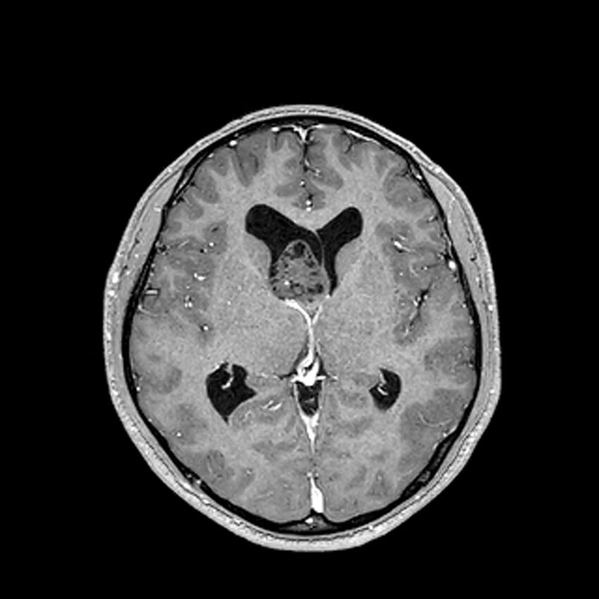 Central neurocytoma (Radiopaedia 79320-92380 Axial T1 C+ 127).jpg