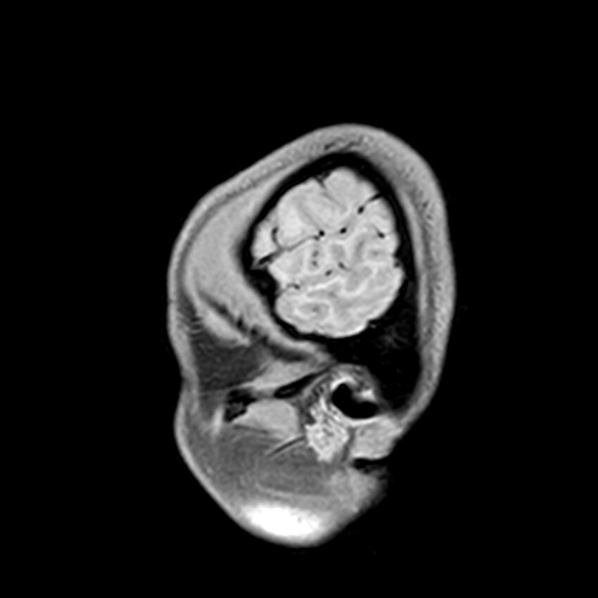 Central neurocytoma (Radiopaedia 79320-92380 Sagittal T1 28).jpg