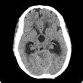 Cerebellar abscess secondary to mastoiditis (Radiopaedia 26284-26412 Axial non-contrast 65).jpg