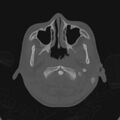 Cerebellar abscess secondary to mastoiditis (Radiopaedia 26284-26413 Axial bone window 9).jpg