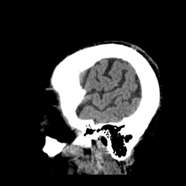 File:Cerebellar hemorrhage (Radiopaedia 27193-27359 C 40).jpg