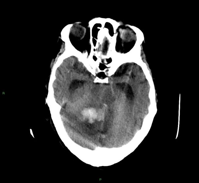 File:Cerebellar hemorrhage (Radiopaedia 58792-66026 Axial non-contrast 34).jpg