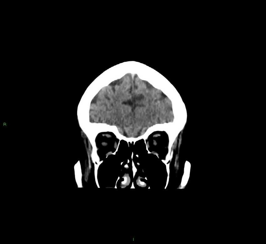 Cerebellar hemorrhage (Radiopaedia 58793-66027 Coronal non-contrast 54).jpg